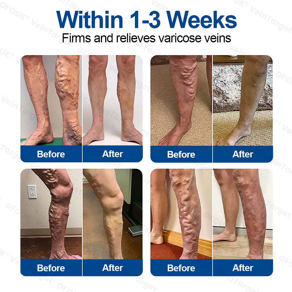 🇬🇧👨‍⚕️✅GFOUK® VeinTarget Microneedle Patch⚡Instant Relief, Long-Term Results